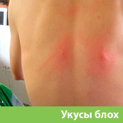 Укусы блох в Иркутске
