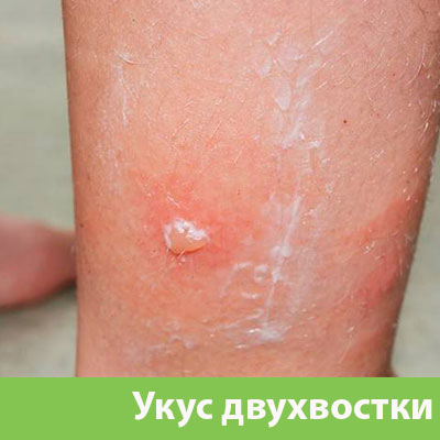 Укус двухвостки в Иркутске
