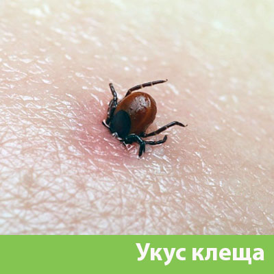 Укус клеща в Иркутске