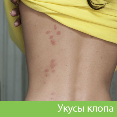 Профессиональное уничтожение клопов в Иркутске